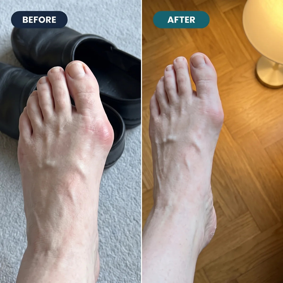 Goluxera EMS Pro Bunion Corrector