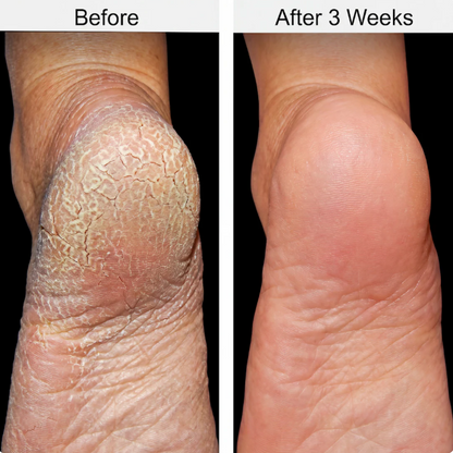 Maximum Strength 60% Urea Foot Repair Stick