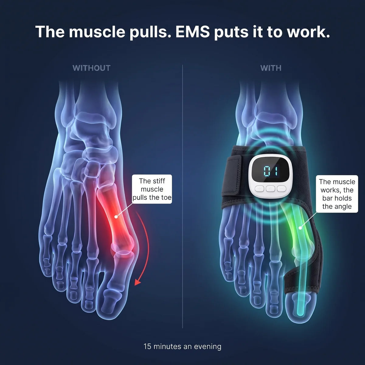 Goluxera EMS Pro Bunion Corrector