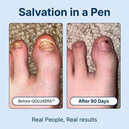 Maximum Strength Antifungal Pen